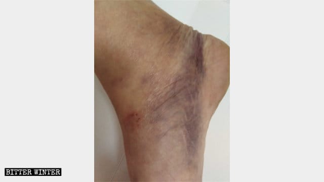 El pie de Wei Lihui se lesionó durante los ataques a los que fue sometido.