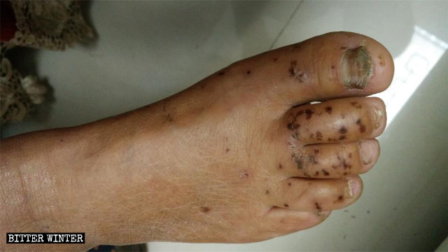 En los pies de la miembro de la IDT que fue sometida a torturas mediante descargas eléctricas aún pueden verse marcas oscuras provocadas por las quemaduras.